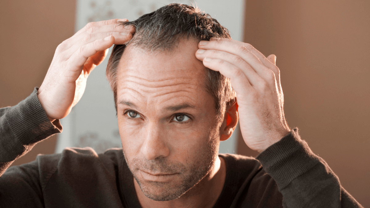Man checking his hair loss MSN